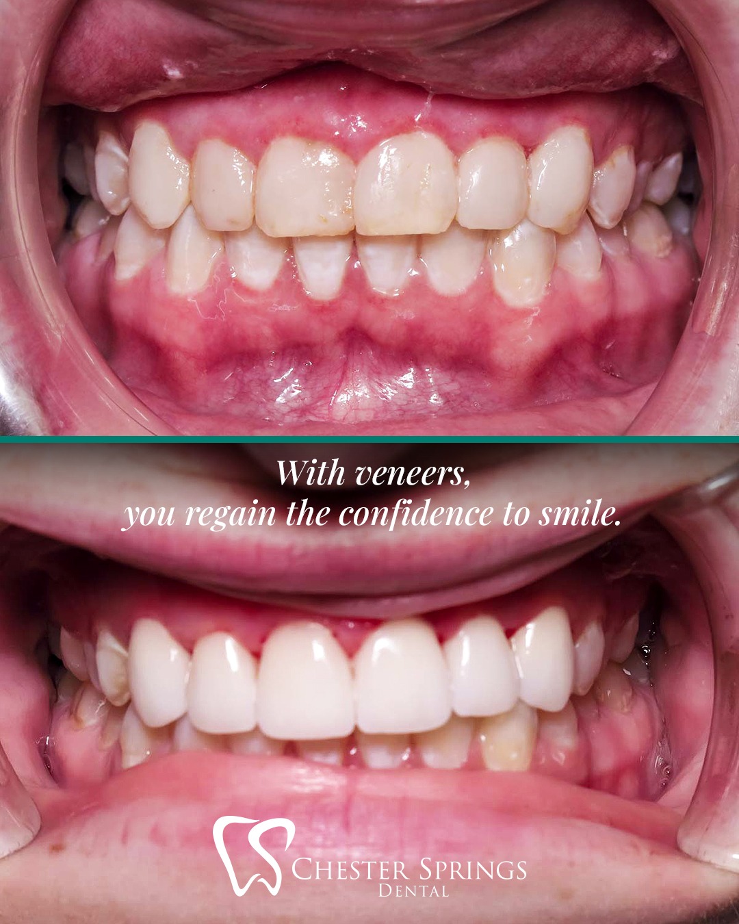 With veneers, you can smile, speak, and live with total confidence—just like they’re your own teeth. 😁
Imagine enjoying your favorite foods without hesitation, speaking freely without worrying about chips or gaps, and showing off a bright, flawless smile that feels like you.
👉 Veneers are the perfect solution for anyone looking to enhance their smile. These thin, custom-made shells are bonded to your natural teeth to improve their shape, color, and overall appearance—instantly elevating your confidence.
The solution is here! ✅ Don’t let insecurity hold your smile back. Schedule a consultation with Dr. Gross and discover how veneers can transform your look—and your life.
ChesterSpringsDental.com | 610.524.9530
#ChesterSpringsDental #VeneersExton #CosmeticDentistry #SmileMakeover #ExtonSmiles #PorcelainVeneers #SmileGoals #ConfidenceStartsHere #DentalCare #ChesterSprings