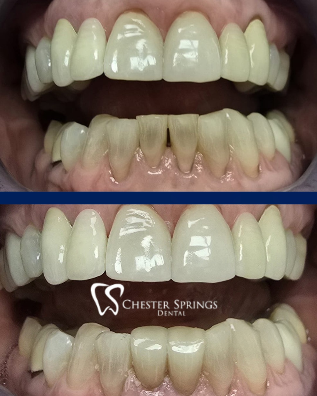 Just two porcelain veneers on the lower front teeth—and what a difference! 😍
Our patient wanted to bring those teeth forward, and the final result was nothing short of amazing. He absolutely loved his new smile, and we couldn’t be happier for him!
There’s nothing better than seeing our patients walk out feeling more confident. 🙌
Looking for your go-to dental team in Exton, PA? We’ve got you covered for everything from cosmetic upgrades to everyday care. 🦷✨
📞 Book your appointment today at 610-524-9530 or visit ChesterSpringsDental.com
#ChesterSpringsDental #DrGross #PorcelainVeneers #SmileMakeover #ExtonPADentist #BeforeAndAfter #CosmeticDentistry #Veneers #HappySmiles #ConfidenceBoost