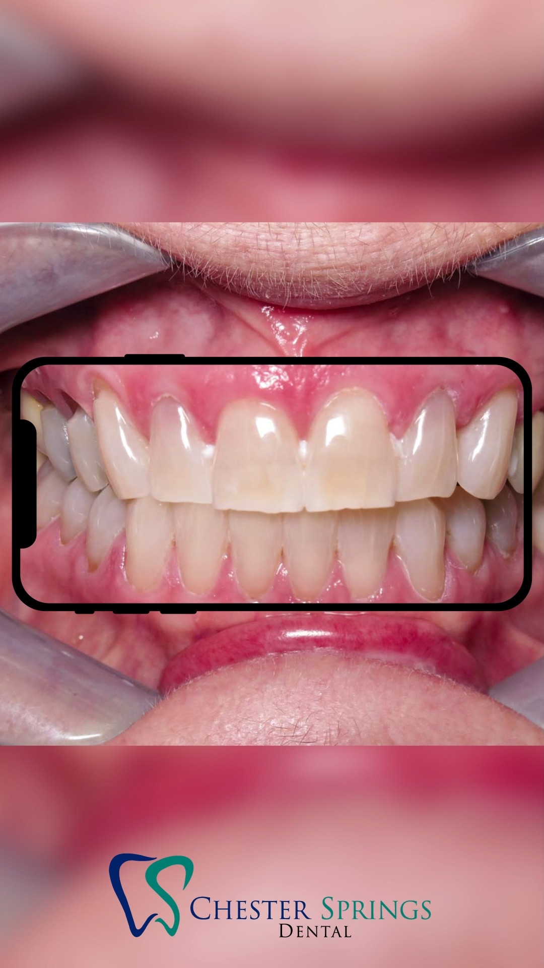 Wondering why teeth change color? 😬☕🍷
From coffee to age, many factors can dull your smile—but we can help bring the shine back!
Learn what causes discoloration and how to brighten your smile. 👉 ChesterSpringsDental.com/what-is-tooth-discoloration
#ChesterSpringsDental #TeethWhitening #ToothDiscoloration #SmileBright #HealthySmiles #ExtonDentist #CosmeticDentistry #SmileMakeover