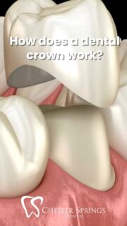 A crown fit for a smile. 👑✨

Curious how dental crowns protect and restore your teeth? Watch this quick breakdown—then learn more about the full procedure here:
👉 ChesterSpringsDental.com/the-dental-crown-procedure

#ChesterSpringsDental #DentalCrowns #RestorativeDentistry #SmileRestoration #HealthyTeeth #ExtonDentist #ModernDentistry #SmileConfidently