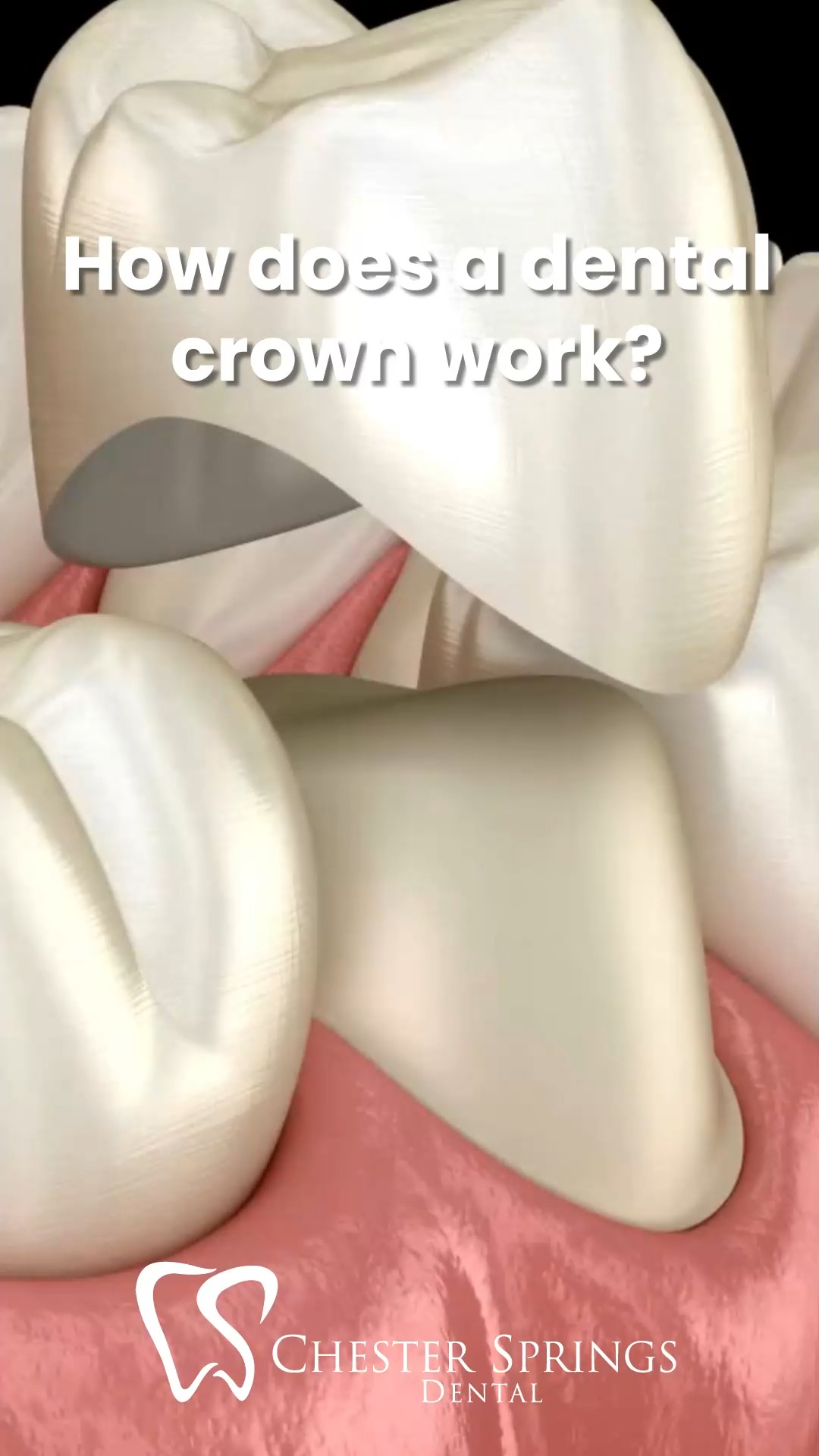A crown fit for a smile. 👑✨

Curious how dental crowns protect and restore your teeth? Watch this quick breakdown—then learn more about the full procedure here:
👉 ChesterSpringsDental.com/the-dental-crown-procedure

#ChesterSpringsDental #DentalCrowns #RestorativeDentistry #SmileRestoration #HealthyTeeth #ExtonDentist #ModernDentistry #SmileConfidently