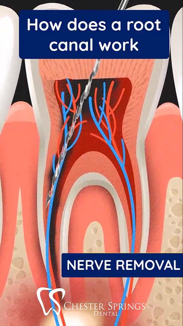 Root canals don’t have to be scary. 👻🦷
Here’s a quick look at how this treatment actually saves your tooth—and your smile!
Learn more on our website. 👉 ChesterSpringsDental.com

#ChesterSpringsDental #RootCanalTreatment #Endodontics #SaveYourSmile #ExtonDentist #DentalCare #HealthyTeeth #PainFreeDentistry