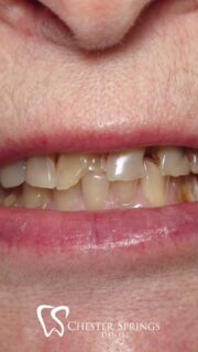 Strong. Beautiful. Long-lasting. 💎
Zirconia crowns are the perfect blend of durability and aesthetics—made to restore your smile with natural-looking strength.
See the difference for yourself 👇
👉 ChesterSpringsDental.com

#ChesterSpringsDental #ZirconiaCrowns #SmileTransformation #RestorativeDentistry #BeforeAndAfter #ExtonDentist #HealthySmiles