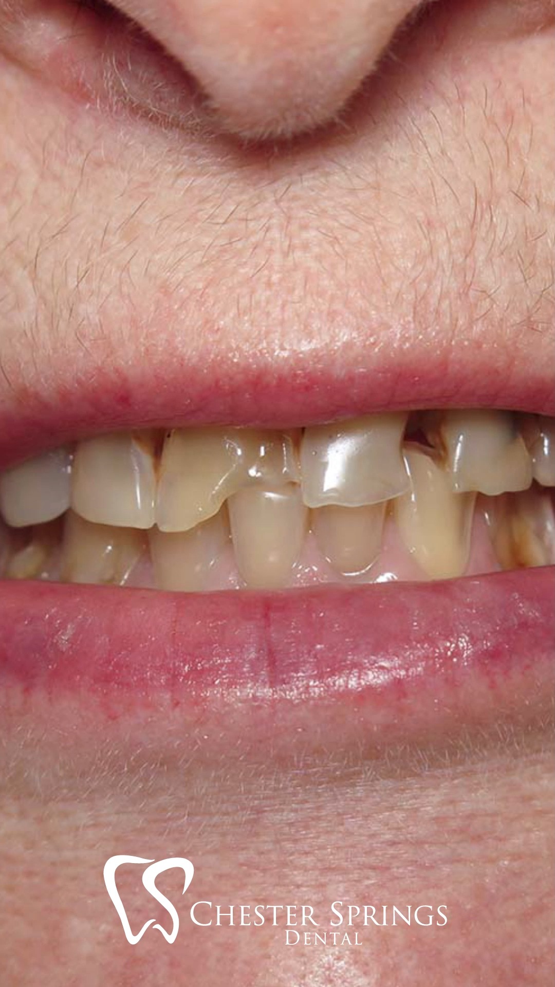 Strong. Beautiful. Long-lasting. 💎
Zirconia crowns are the perfect blend of durability and aesthetics—made to restore your smile with natural-looking strength.
See the difference for yourself 👇
👉 ChesterSpringsDental.com

#ChesterSpringsDental #ZirconiaCrowns #SmileTransformation #RestorativeDentistry #BeforeAndAfter #ExtonDentist #HealthySmiles