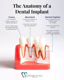 Ever wondered what makes a dental implant look and function like a natural tooth?

Thanks to decades of advancements in implant dentistry, today's dental implants are designed to feel secure, look natural, and function just like your own teeth.

Did you already know how dental implants work? Let us know in the comments! 👇
🌐 ChesterSpringsDental.com

#ChesterSpringsDental #DentalCare #ChesterSprings #Dentist #DentalImplants #ToothReplacement