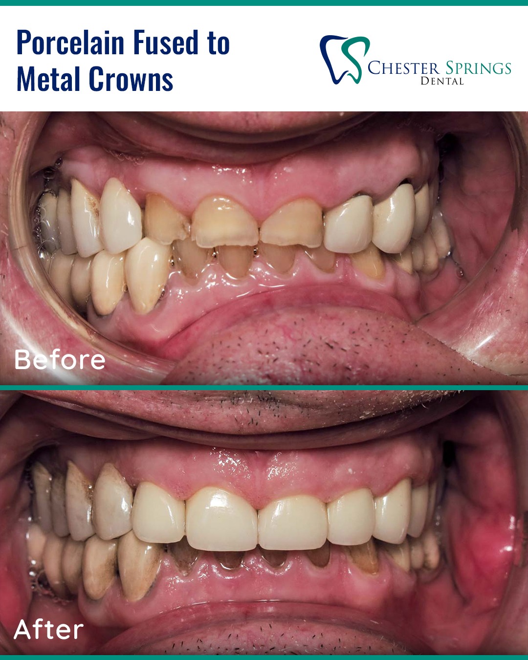 Durability meets beauty! ✨ These porcelain-fused-to-metal crowns restored this smile with strength and a natural look. Ready for your transformation?
Call us today! 📞 610.524.9530
#ChesterSpringsDental #SmileWithCare #ExtonDentist #PFMCrowns #SmileMakeover #Exton