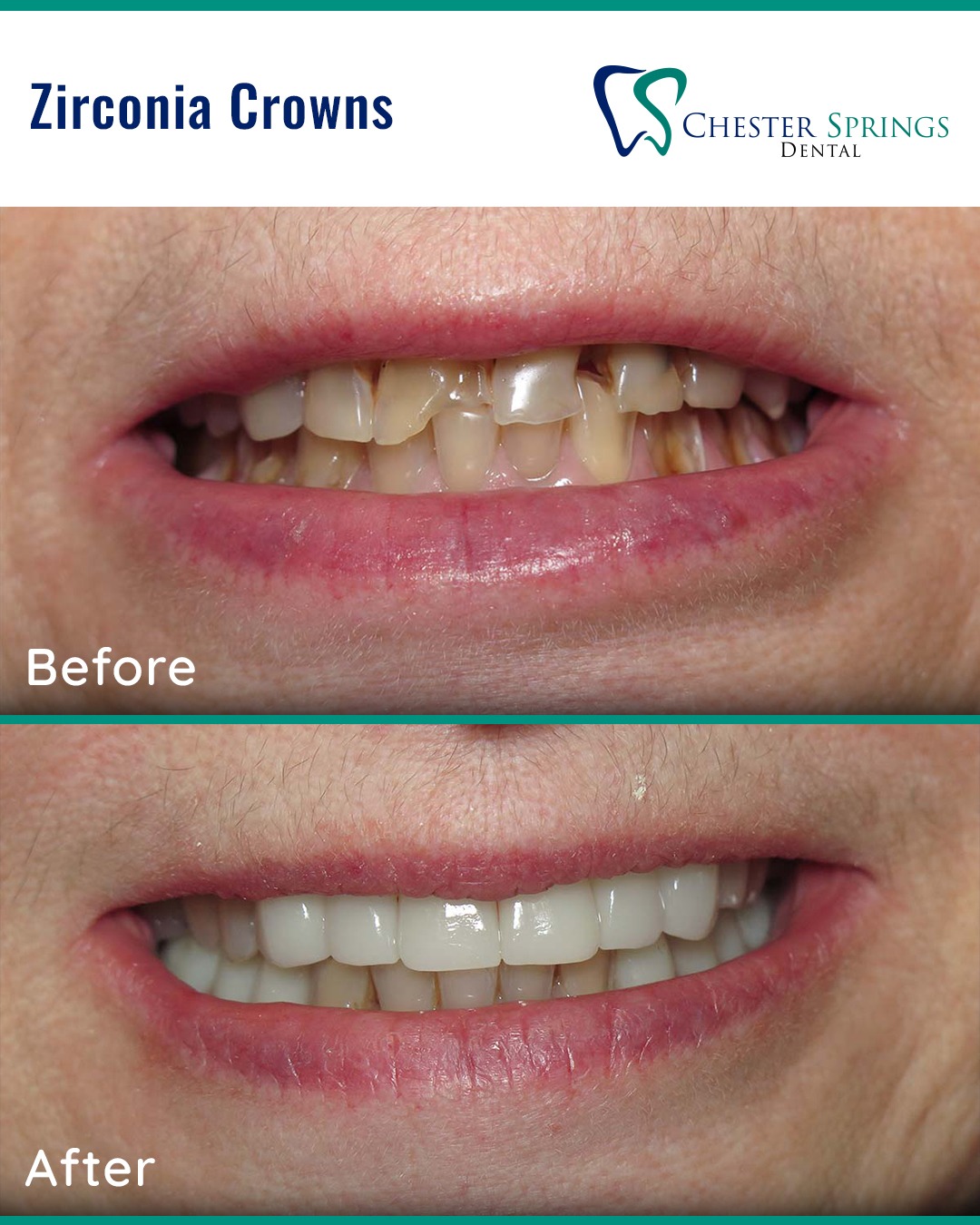 Strong, natural-looking, and built to last! 💎 These zirconia crowns brought this smile back to life. Ready for your own transformation? Call us today! 📞 610.524.9530

#ChesterSpringsDental #SmileWithCare #ExtonDentist #ZirconiaCrowns #SmileMakeover #Exton